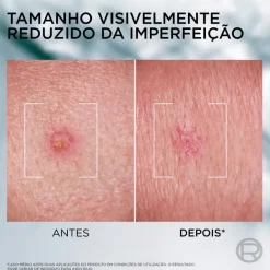 Creme de Rosto Men Expert Derma Control SOS Pimple Paste